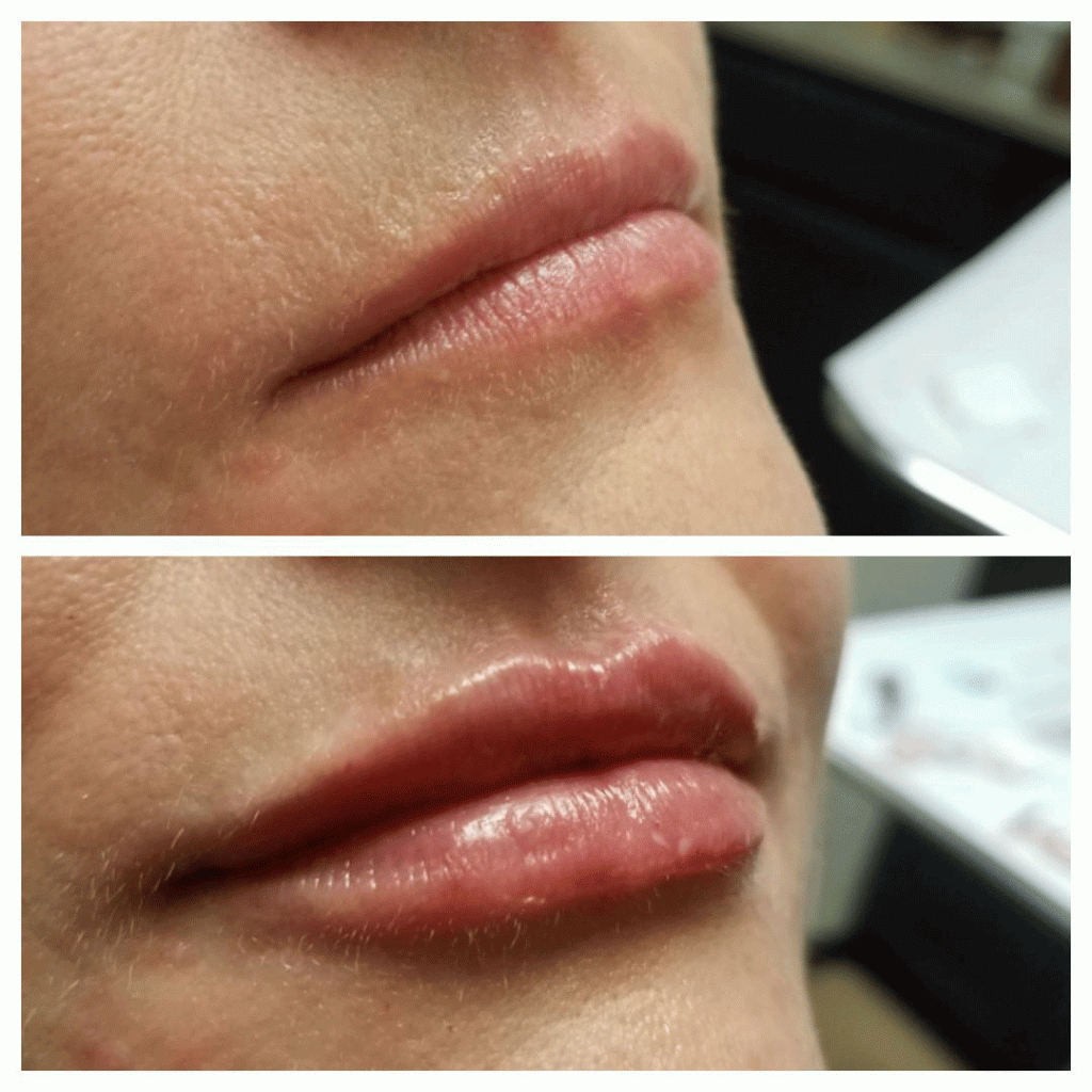 Owsley_Plastic_Surgery_Coeur_d_Alene_Idaho_Fillers_Before_and_After7