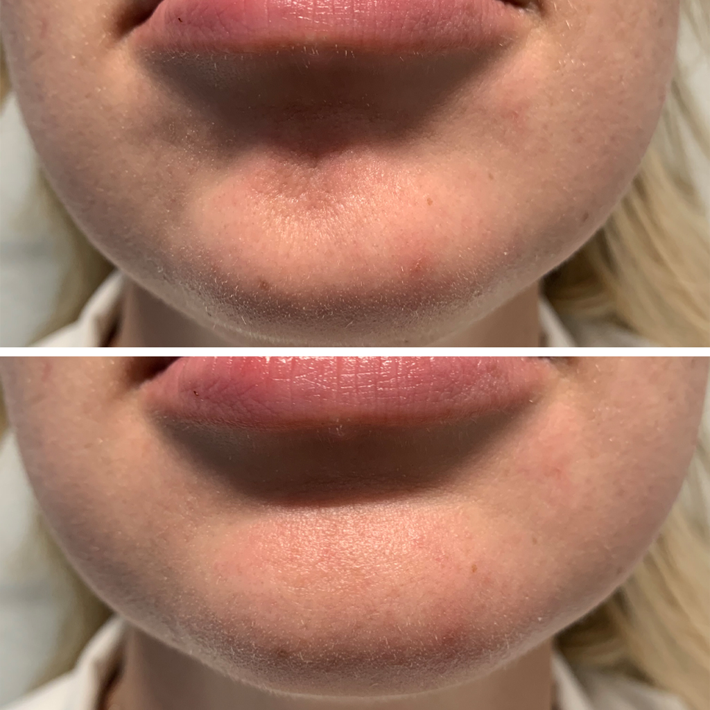 Owsley_Plastic_Surgery_Coeur_d_Alene_Idaho_Chin_Botox_Before_and_After_2_1024x1024